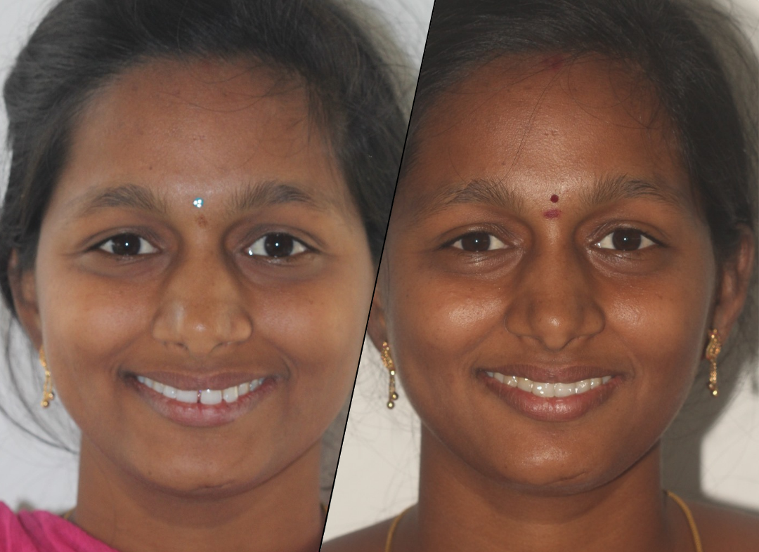 Treatment Before